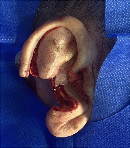 Defect measuring 1.2 cm following the excision of the invasive squamous cell carcinoma.