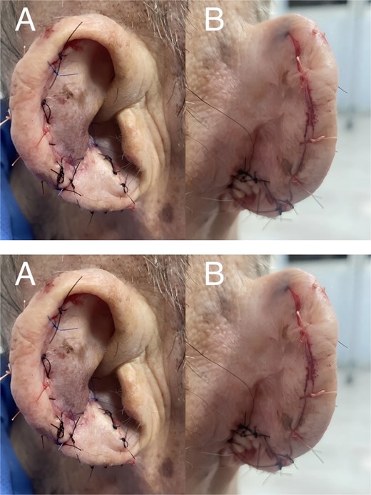 Immediate post-surgical reconstruction: A) Lateral view B) Posterior view.