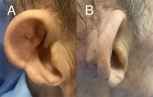 Approximately 1 year after reconstruction: A) Lateral view B) Posterior view.