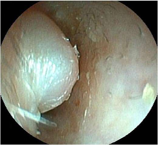 Endoscopic view of the auditory canal. Swelling of the anterior wall of the left lateral auditory canal.