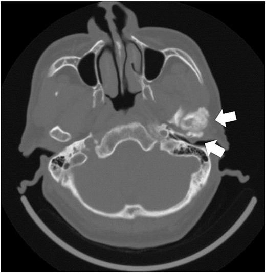 Axial section image of bone conditions on contrast-enhanced CT. CT image shows enlargement of the left temporomandibular head and a mass in the external auditory canal.
