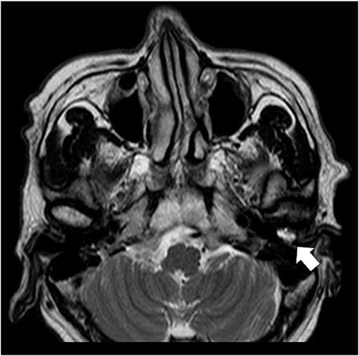 Axial T2-weighted MRI. MRI image shows a high-signal area in the left external auditory canal.