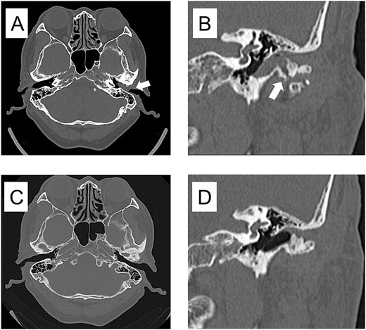 CT imaging findings when the mass was enlarged and the ear canal was obstructed and 3 years after surgery. (A) Axial section CT shows occlusion of the left external auditory canal. (B) Coronal section CT shows a bone defect from the temporomandibular joint to the external auditory canal. (C) Axial section of postoperative 3 years CT shows resolution of the mass in the external auditory canal. (D) Coronal section of postoperative 3 years CT shows restoration of bone defects from the TMJ to the external auditory canal.