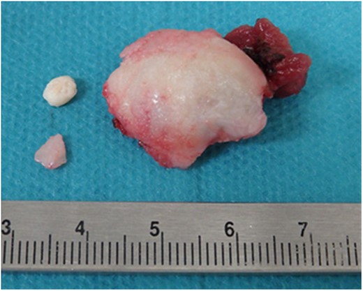 Resected mandibular head and surrounding calcification.