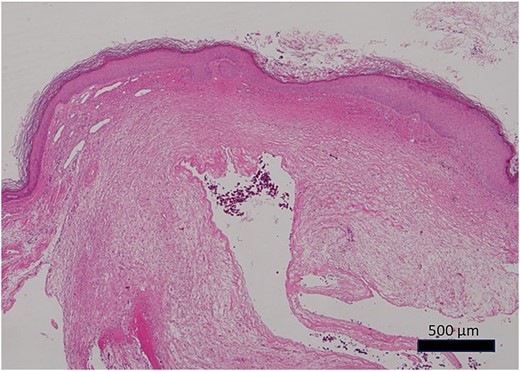 Photomicrograph of the histopathological specimen (HE staining). The cyst had no epithelial covering, mixoid-like changes, and ganglion-like findings.