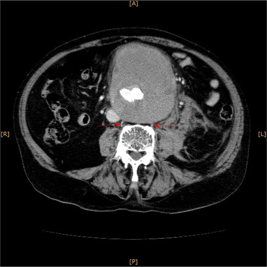Contrast-enhanced CT revealed an AAA measuring 118 × 107 mm and left retroperitoneal hematoma. One pair of lumbar arteries was enhanced only in the delayed phase (red arrows). Intraoperatively, pulsatile bleeding was observed from the left one of this pair.