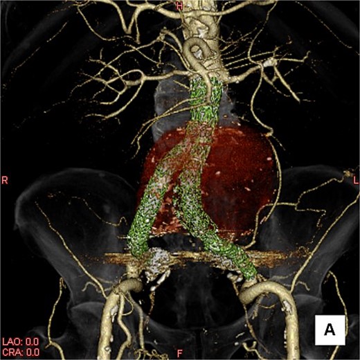 A three-dimensional image. The AAA is shown in transparent red, and the framework of the stent grafts is displayed in green. The landing zones and overlaps of the stent grafts were satisfactory.