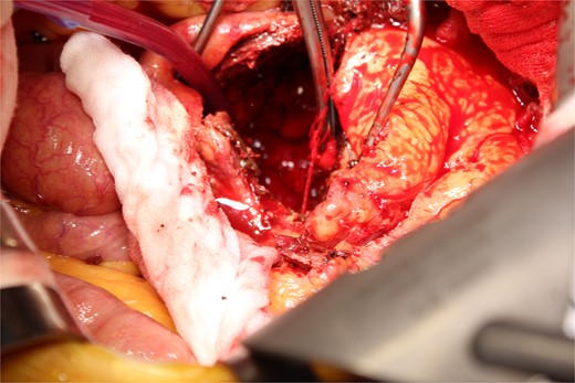 A photo taken from the cranial side of the patient. A jet of bleeding was identified from a lumbar artery.