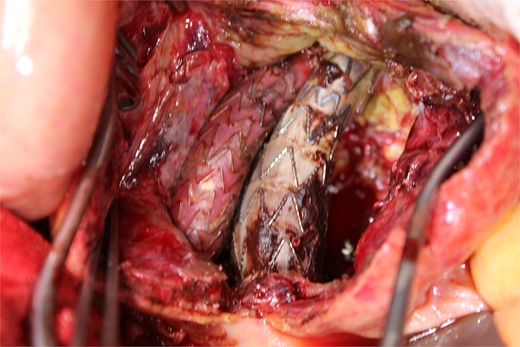 A photo taken from the caudal side of the patient. No endoleaks other than the type II endoleak were observed.