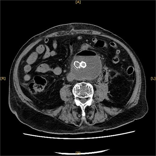 A plain CT on POD 14 showed a reduction in the aneurysm size with no apparent leaks.