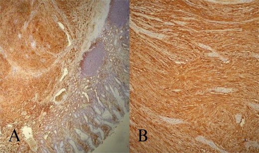 Abdominal CT and MRI images. Contrast enhanced axial tomography revealed a hipodens mass with smooth boundary located at the greater curvature of the stomach. Axial T1 weighted MRI revealed a hypointense, moderate contrast enhancing mass with smooth boundary located at the gastric antrum.