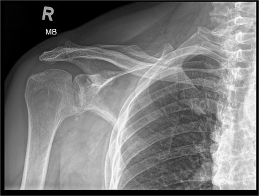 X-ray image before the surgery—AP projection.