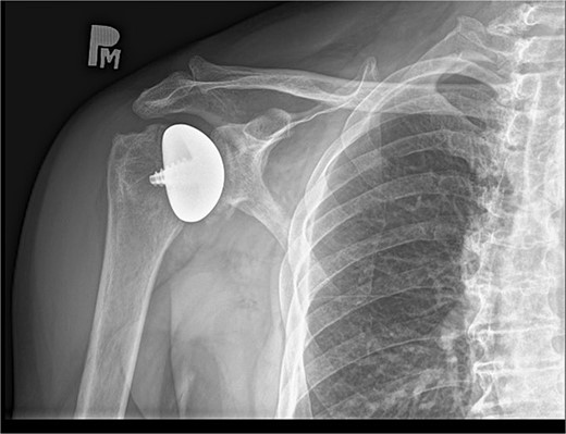 X-ray image after 16 days from the surgery.