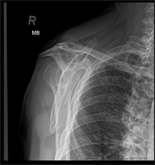 X-ray image before the surgery—Y projection.