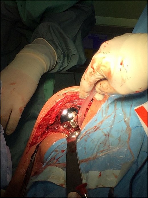 Intraoperative photo.