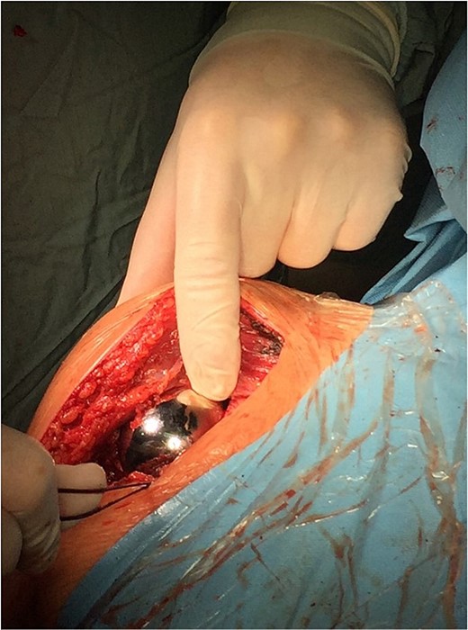 Intraoperative photo.