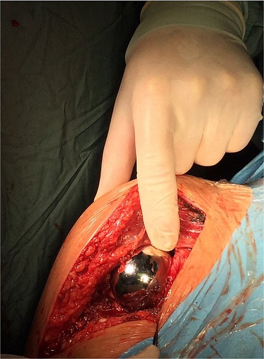 Intraoperative photo.