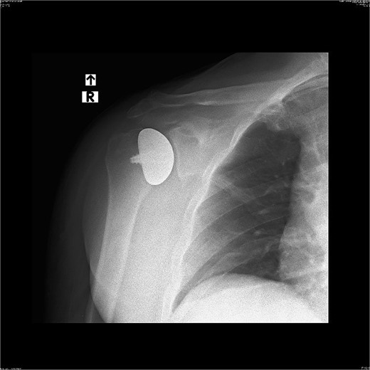 X-ray image after the surgery.