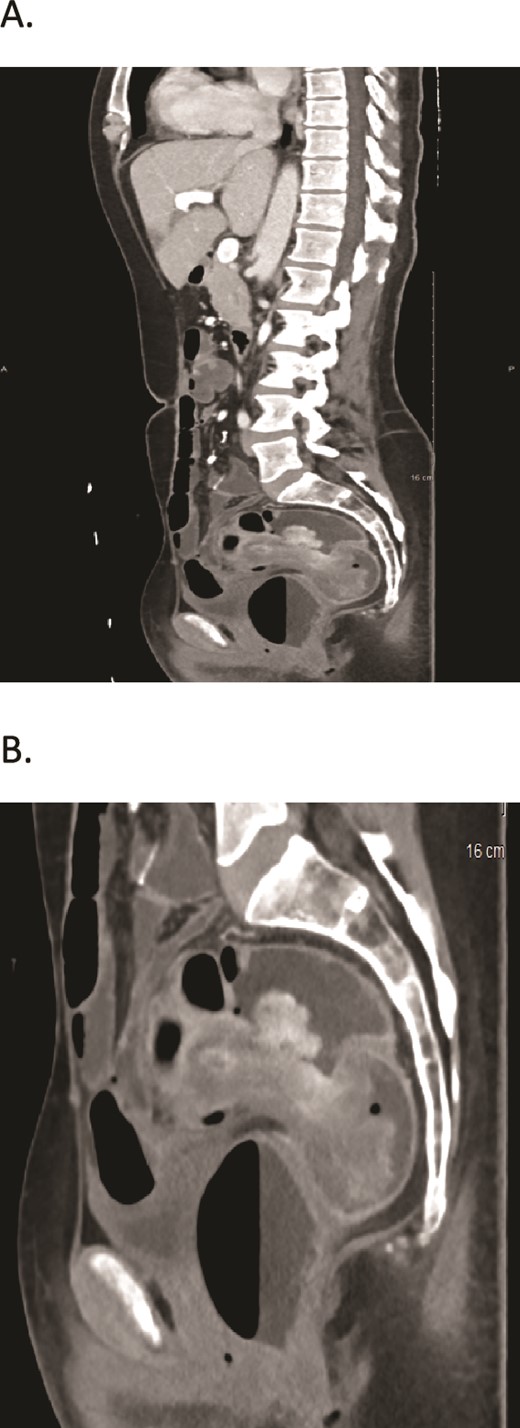 (A, B) CT scans show two large fungating intraluminal sigmoid masses. The largest is 5 × 5.5 × 4.3 (AP, transverse), about 10 cm from the anal verge, and associated with “target sign” in the sigmoidorectal area.