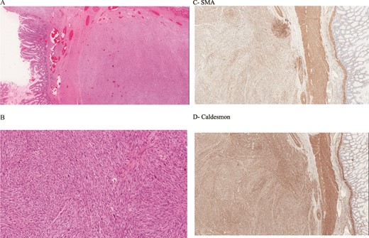 (A, B) Histology image shows spindle-shaped cells with plump, blunt-ended nuclei and moderate to abundant, pale to brightly eosinophilic fibrillary cytoplasm. The cells are arranged in long intersecting fascicles with abundant mitosis. The nuclei exhibit moderate nuclear pleomorphism. (C) Positive for SMA stain. (D) Caldesmon.