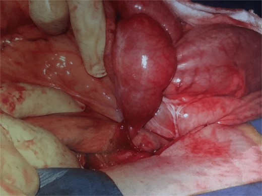 Adhesion band with trapped bowel. With permission, www.dssurgery.com.