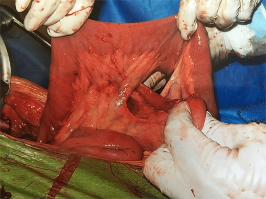 Internal hernia. With permission, www.dssurgery.com.