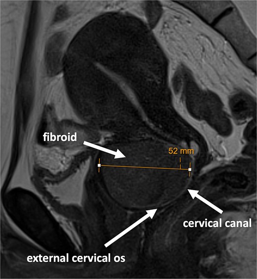MRI scan showing large fibroid within the anterior cervical stroma with compression of the cervical canal.