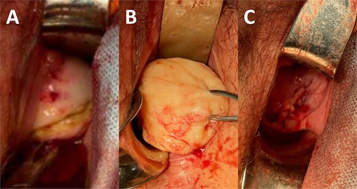 (A) Incision in the anterior lip of the cervix. (B) Enucleated cervical fibroid. (C) Closure of incision at the end of the procedure.