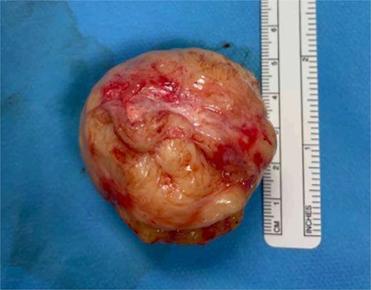 Benign leiomyoma retrieved following vaginal myomectomy.