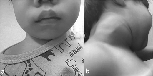 Physiologic findings when crying. (a) smiling and (b) crying.