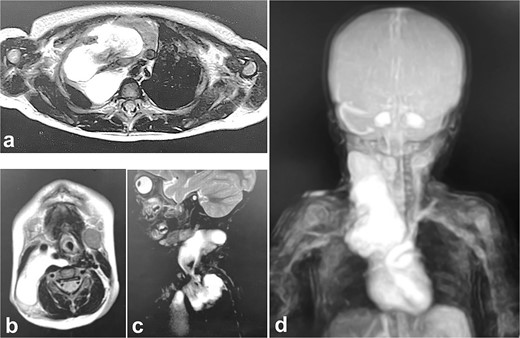 MRI at evaluation after 2 months of Kampo medicine administration. A huge right cervical mediastinal lymphangioma is recognized. (a) Horizontal section in mediastinal region, (b) horizontal section in cervical region, (c) sagittal section in cervical mediastinal region, (d) MRA.