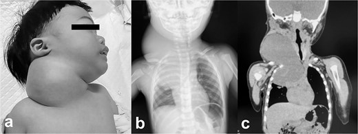 Pathologic findings on the first administration. The tumor size in the cervical region was quite large and there may be a risk of airway system compression. (a) physical finding, (b) chest X-ray, (c) plain computed tomography.