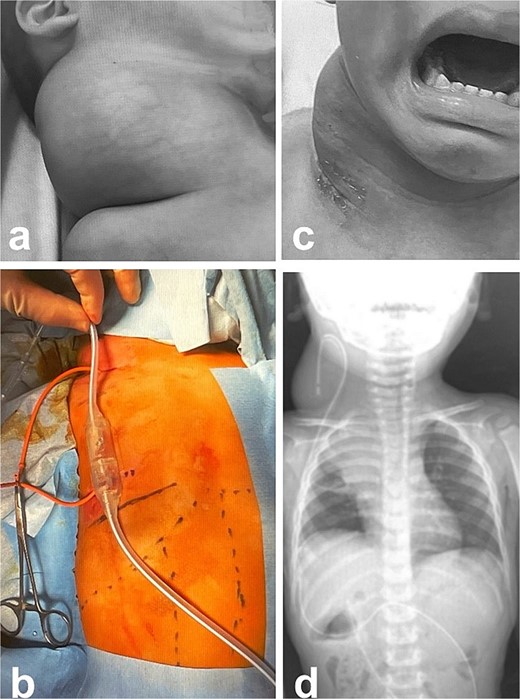 Intra- and post-operative findings from the first operation. (a) Intraoperative findings showed a huge bulge in the right neck. (b) A Denver shunt (peritoneovenous shunt) was inserted from the right cervical region to the abdominal cavity for volume reduction of the cervical cyst to prevent airway obstruction. Pump chamber with backflow prevention valve was implanted in the right anterior chest subcutaneous tissue. (c) Post-operative findings showed a reduction in the right neck swelling, even when crying. (d) The pressure on the trachea was shown to be relieved on the X-ray.