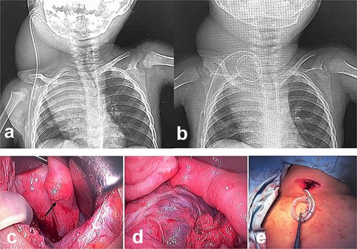 Intra- and post-operative findings from the second operation. (a) The X-ray showed that the tip of the catheter may have moved within the cyst, causing the catheter tip to penetrate the cyst. (b) The X-ray showed the rounded tip of the catheter fixed with threads. (c) Intraoperative findings showed that the tip of the catheter penetrated the cyst wall (black arrow). (d) There were cyst walls with a septum on the mediastinal side of the cyst and when incised old bleeding was noted. The walls were opened as much as possible. (e) The tip of the catheter was rounded and fixed with threads. The catheter was then placed back into the cyst and the wound was closed.