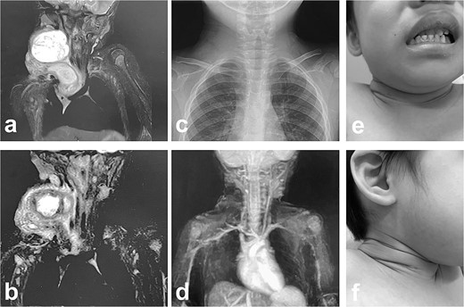 MRI findings after removal of the Denver shunt catheter. (a) MRI findings showed two different areas of intensity in the neck region and the mediastinal region where the Denver shunt was inserted. (b) MRI findings 2 months postoperatively showed that the mediastinal lesion was smaller with near-complete regression. (c) X-ray showed no tumor shadow and no compression of the trachea by the lymphangioma. (d) MRA showed disappearance of the lymphangioma. (e) and (f) Right cervical swelling did not become evident, even when crying (e: crying, f: smiling).