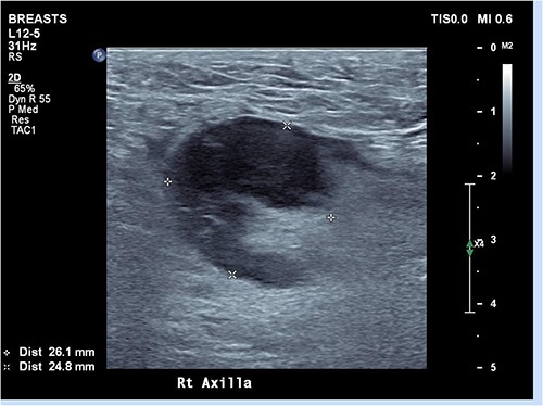 Ultrasound of right axilla showing an enlarged right axillary lymph node. This node retained its fatty hilum but had thickened cortex, measuring up to 13 mm in short axis.