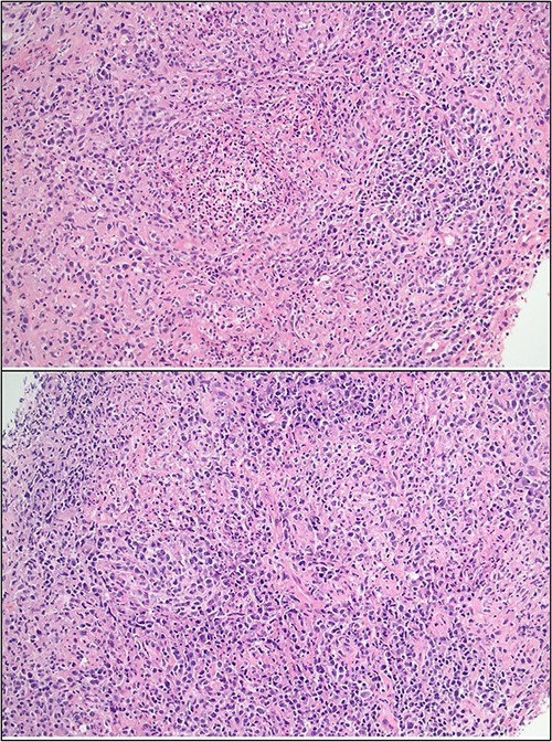 Core biopsy histology showing lymphoid infiltrate with foci of suppuration and dense plasma infiltrate.