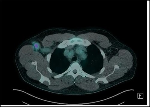 Axial slice of FDG-PET CT scan showing a 22 mm (short-axis) moderately FDG-avid right axillary lymph node (SUV-max 4.19).