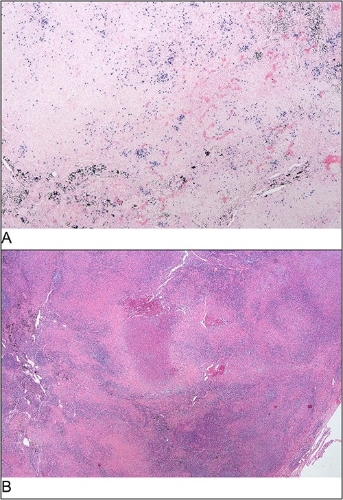 Excisional biopsy histology (A) foci of necrotising granulomatous inflammation; (B) presence of EBER-ish-positive cells.