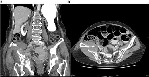 (a) Coronal CT image demonstrating the acetabulum fracture on the right side with herniated mesenteric fat tissue and collapsed small bowel loops (white arrow). (b) Transverse CT image demonstrating dilated small bowel loops and a distinct transition point (white arrow) on the right side close to the acetabulum fracture and a haematoma.