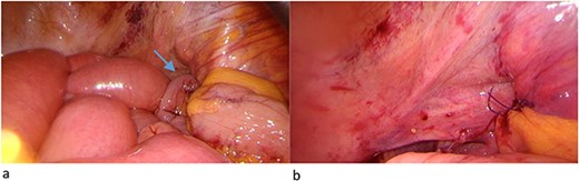 (a) Herniated loop (arrow) between the fractured fragment and (b) mesenterial fat patch.