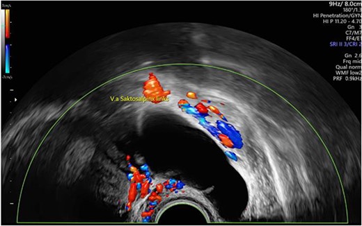 Preoperative sonographic suspicion of hydrosalpinx on the left side (64 × 26 mm2, echo-poor with dorsal sound enhancement).