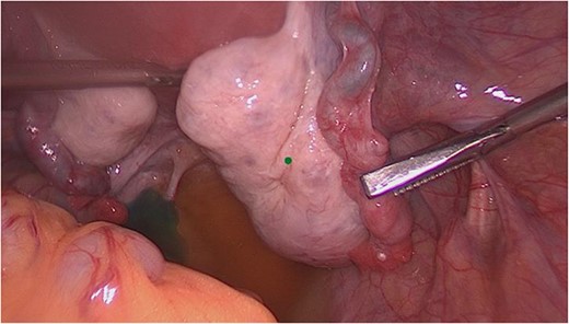 Intraoperative view of the right adnexa (condition after salpingotomy for extrauterine pregnancy).