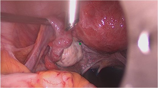 Intraoperative view of the left adnexa.