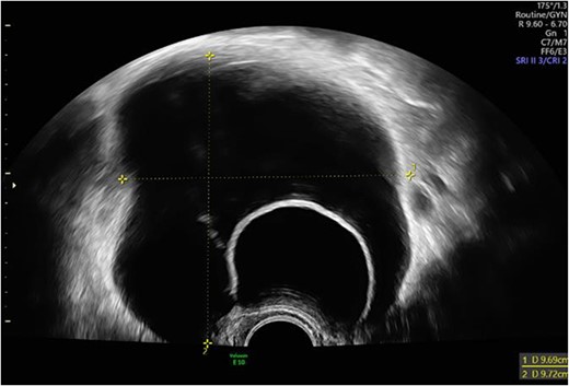 Intravesical cystic mass in the area of the urinary bladder on the left.