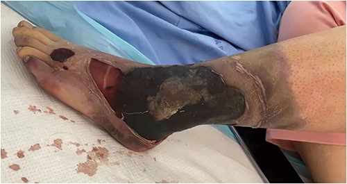 A black necrotic lesion on the left ankle, erythematous blisters and slight edema in the lower leg.