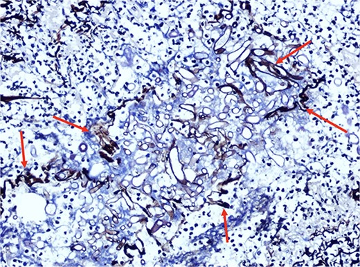 Filamentous fungi were revealed by tissue staining with periodic acid-silver methenamine.