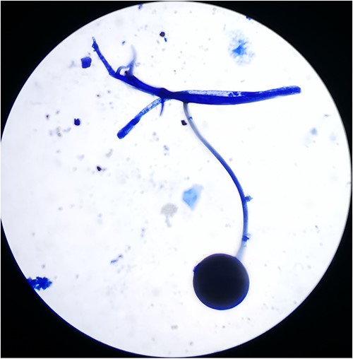 The morphology of the Rhizopus genus on the staining with lactic acid phenol cotton after fungi culture.