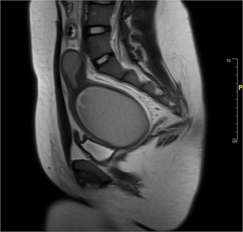 Initial MRI.