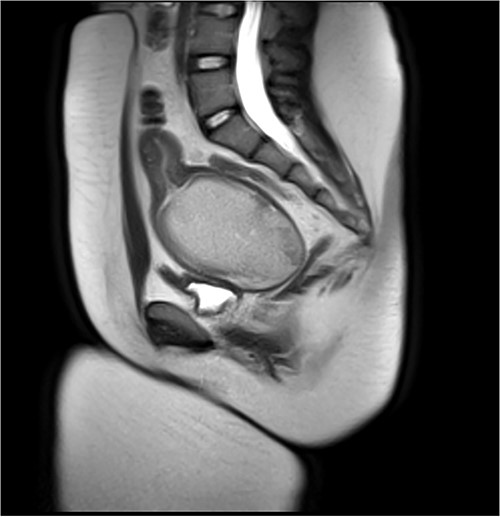 Pre-vaginoplasty MRI- Image was taken after IR drainage and suppression to allow distension pre-vaginoplasty.